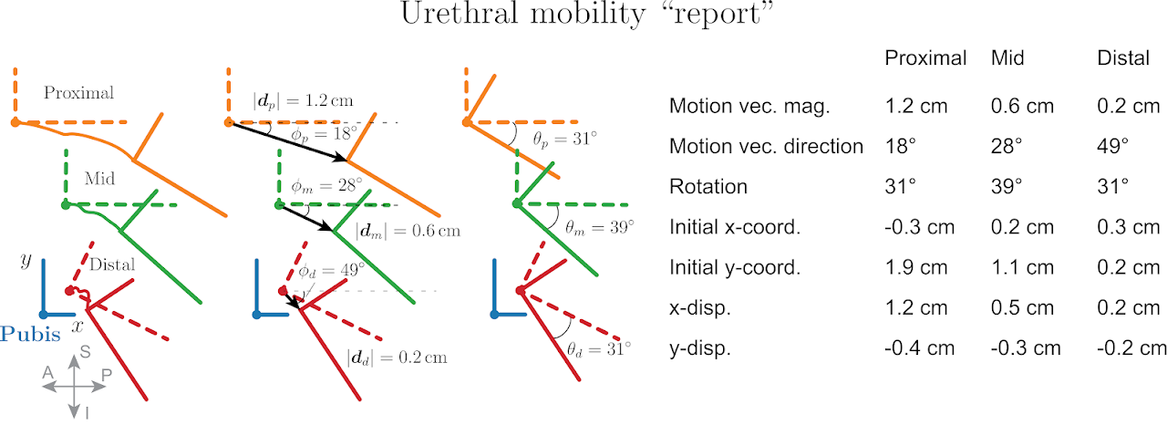 Sample automated report summarizing pelvic floor dynamics: segmental displacements, motion trajectories, and urethral rotation.