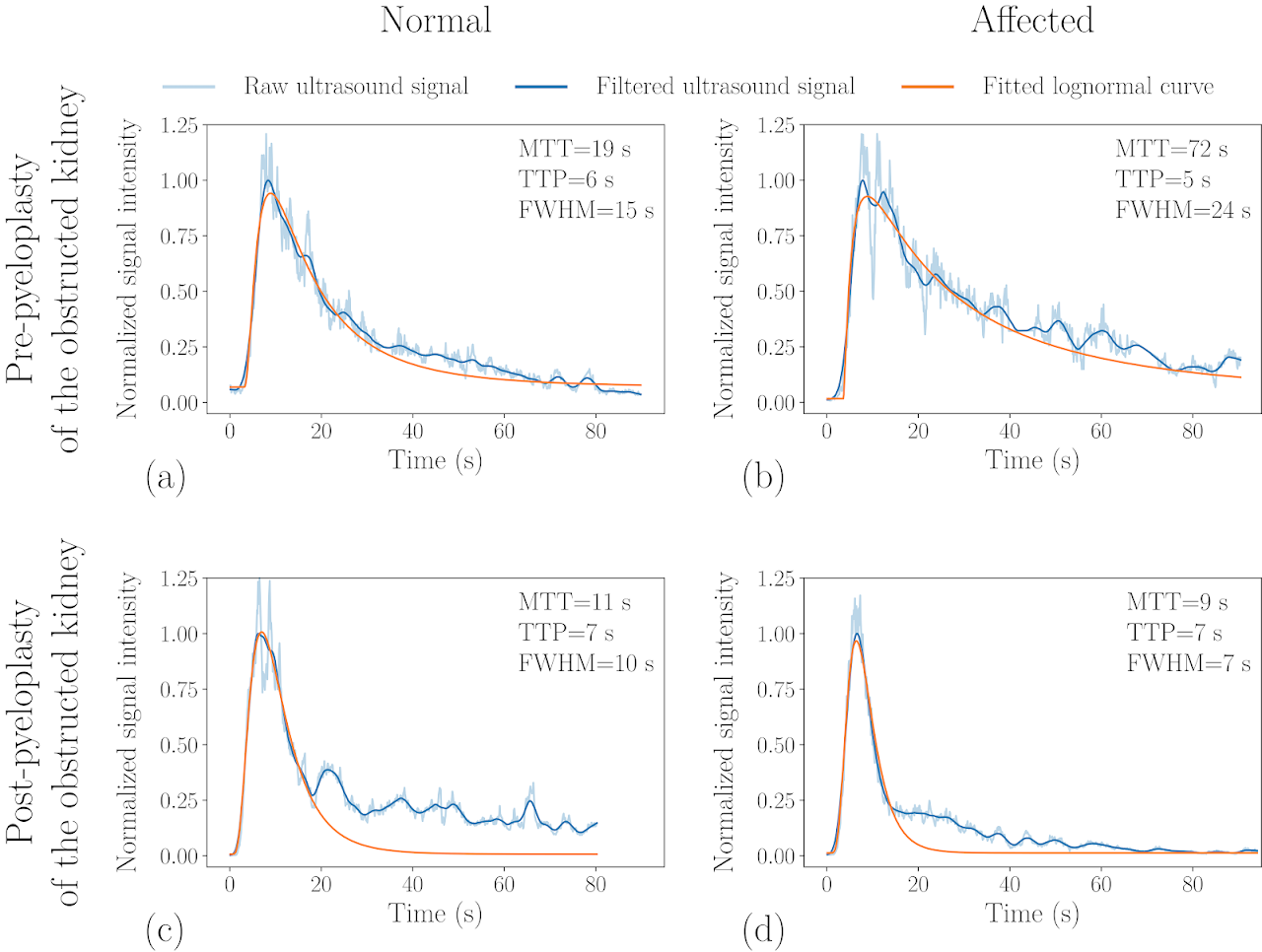 Time-intensity curves comparing normal and affected kidneys before and after pyeloplasty of the obstructed kidney.